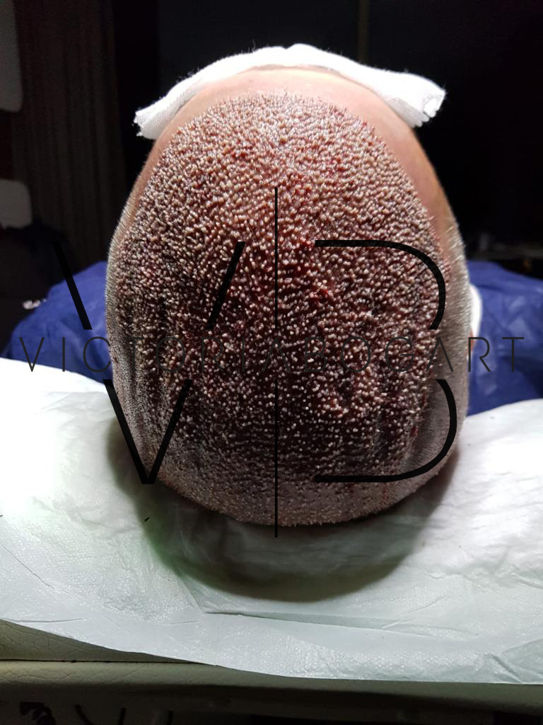 Calicut Before After Result  One of Our Patients Before and After Result  From Calicut VPLANTHAIRCLINIC VPLANT HAIRTRANSPLANT  HAIRTRANSPLANTMUMBAI HAIRTRANSPLANTKOCHI  By VPlant  Advance Hair  Clinic for Hair Transplantation  Facebook