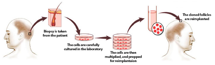 Hair Cloning & Multiplication | Turkey